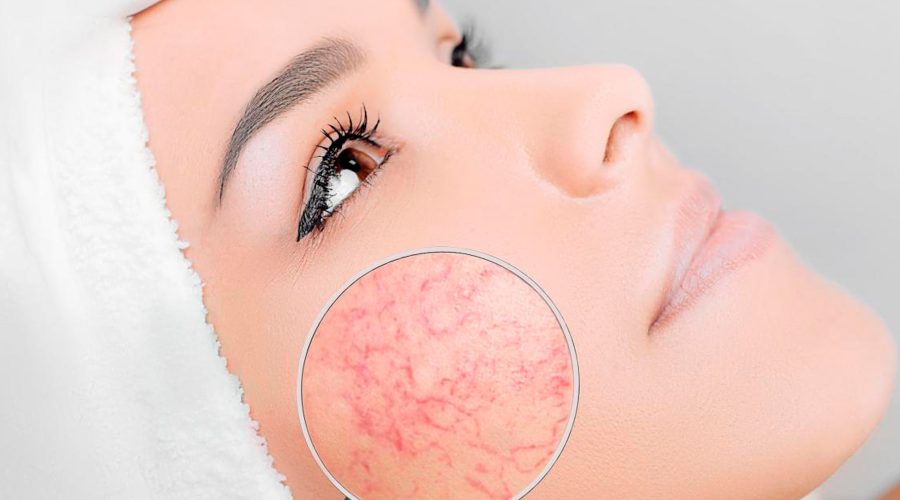 crema-rosacea crema-rosacea